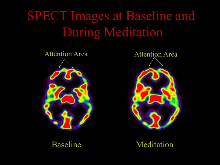 02 spect images at baseline and during meditation