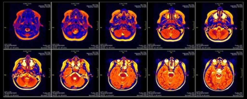 F-MRI, PET Scan, SPECT (single photon emission computed tomography)